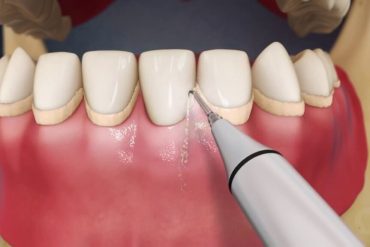 Улучшение функции и эстетики зубов с помощью имплантации Osstem + коронки в стоматологической клинике доктора Лопатина